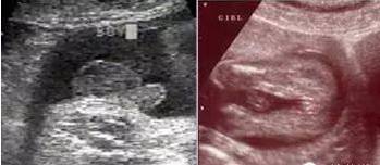 b超监测胎儿发育怎么看男女